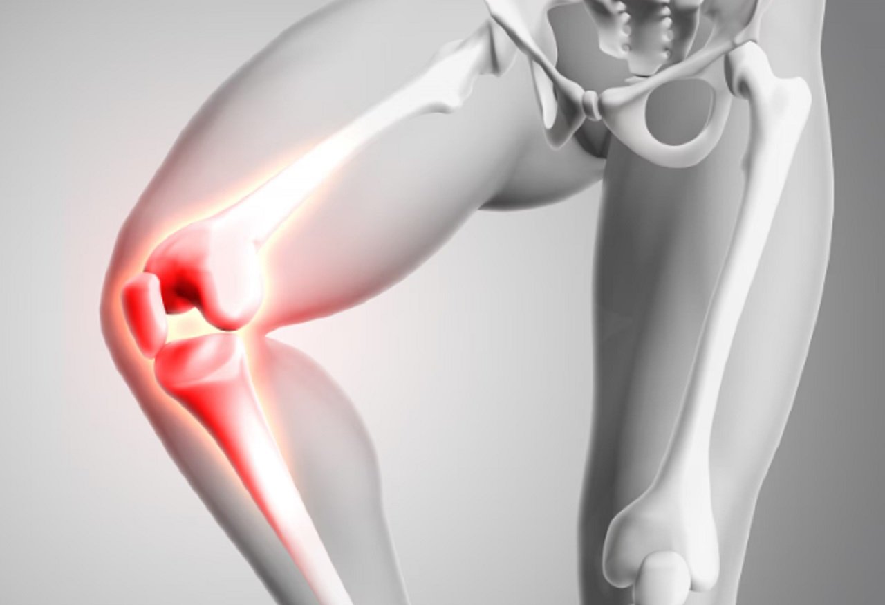 Yüksek Tibial Osteotomi (YTO) Ağrısız Adımlara Doğru Yol Haritası