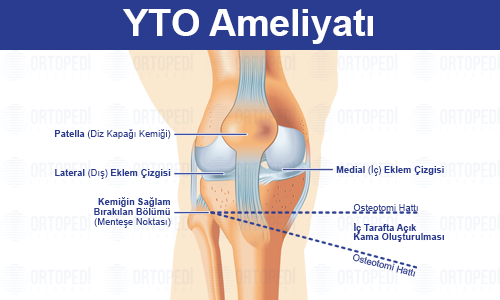 Yüksek Tibial Osteotomi